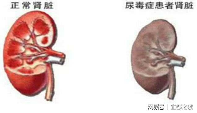 尿毒症克隆肾最新技术，肾脏替代疗法的未来希望